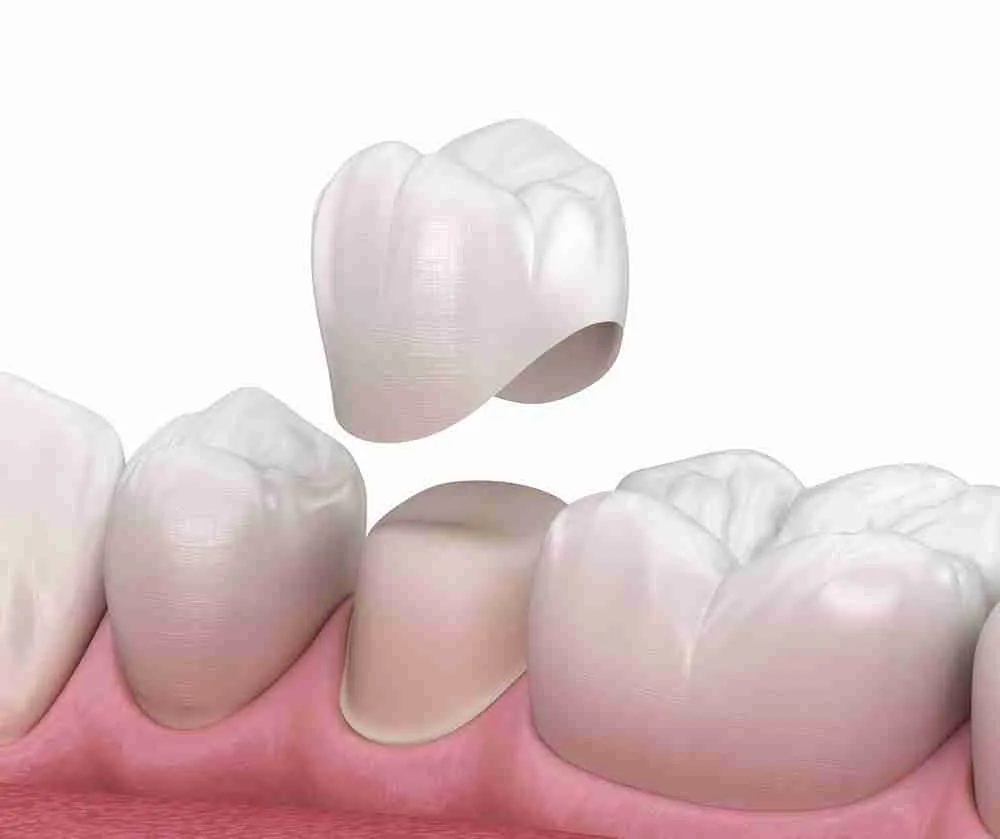 Làm răng sứ là gì?