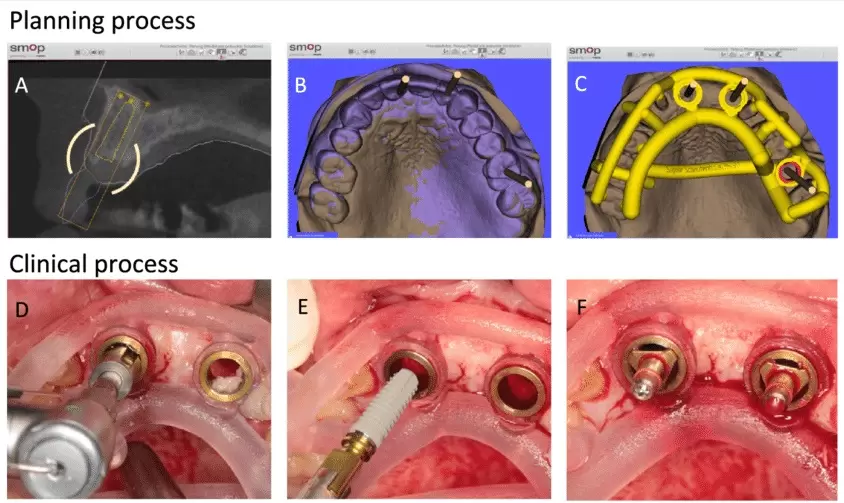 Việc trồng răng implant bằng máng sẽ ít phải xâm lấn hơn.