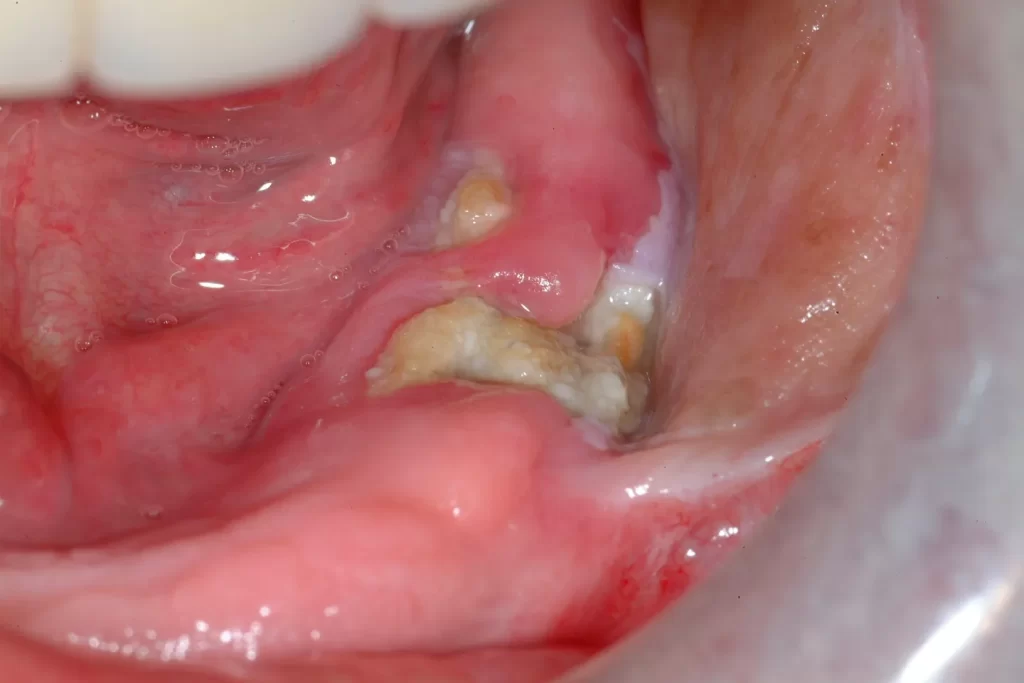 Hoại tử sàn miệng là biến chứng nguy hiểm nhất có thể dẫn đến tử vong