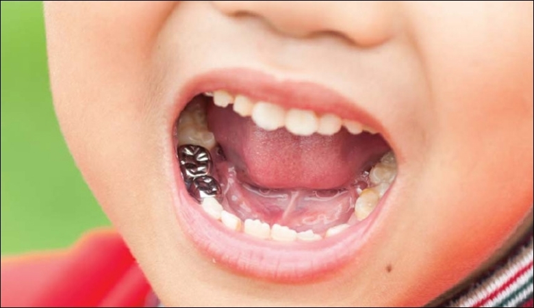 Tổng quan phương pháp chụp thép răng sữa cho trẻ em