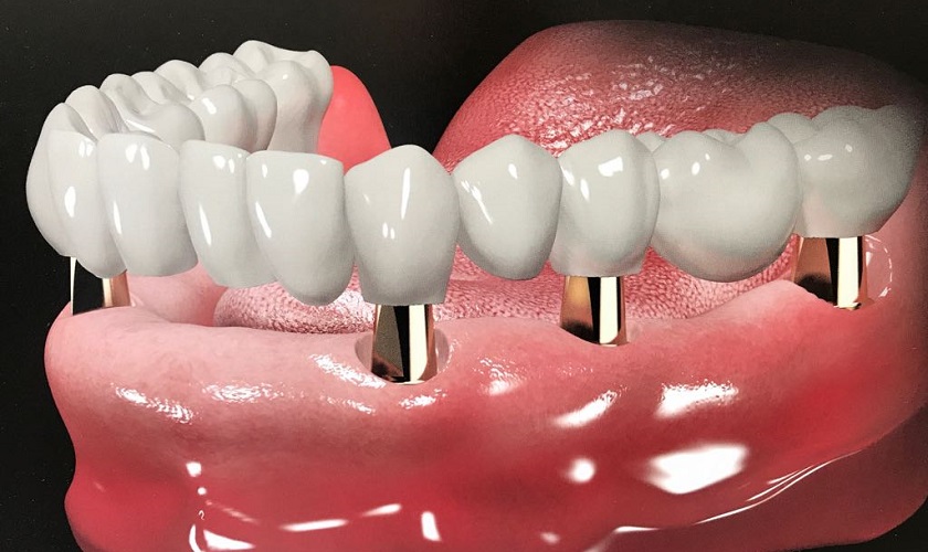 Trồng Răng Implant Toàn Hàm Là Gì? Quy Trình Và Chi Phí Implant Toàn Hàm Tại Platinum Dental