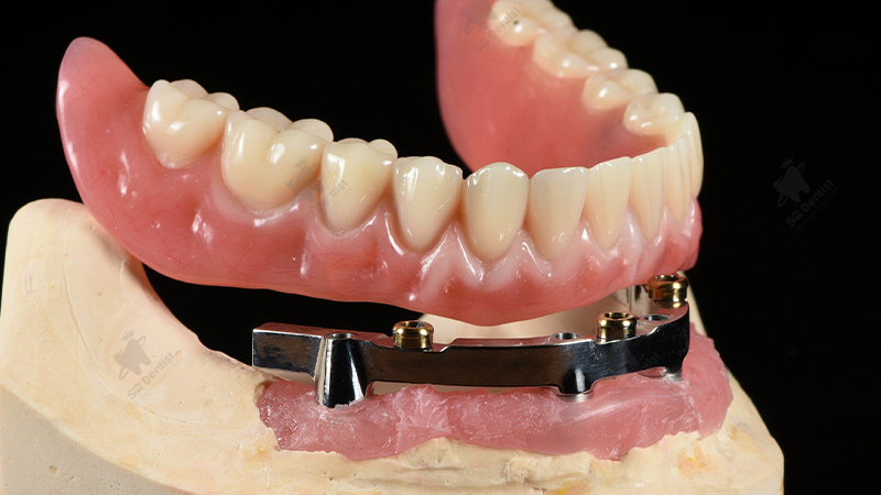 Trồng Răng Implant Toàn Hàm: Giải Pháp Cho Nụ Cười Hoàn Hảo