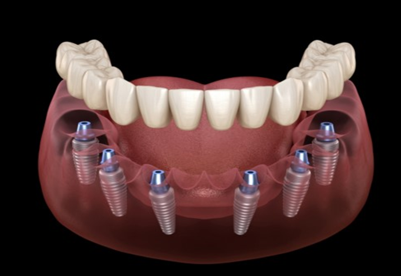 Trồng răng implant toàn hàm có những ưu điểm gì?